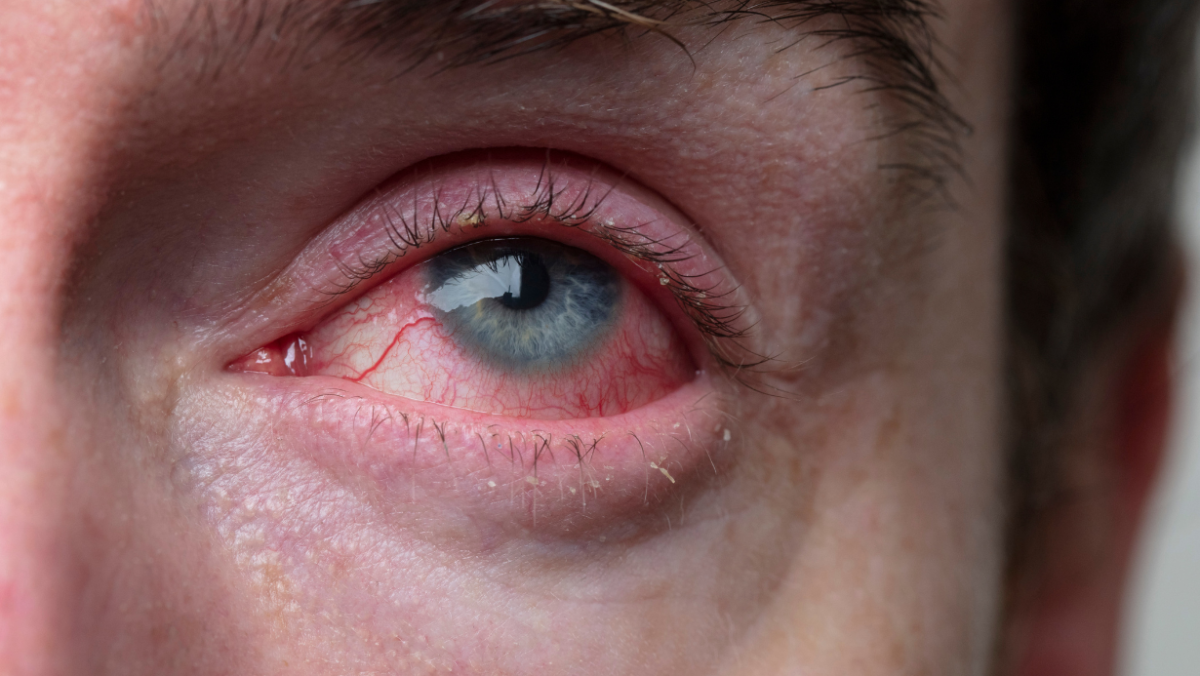Mumbai conjunctivitis cases - Eye infection