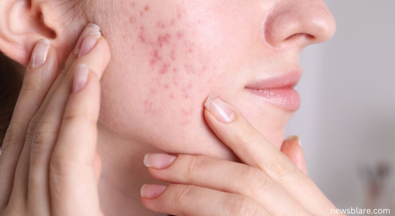 How to deal with hormonal acne?