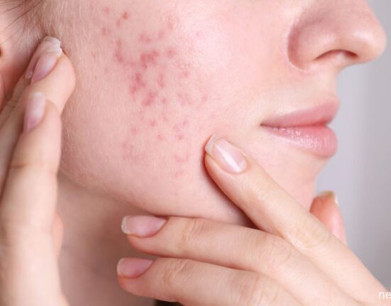 How to deal with hormonal acne?