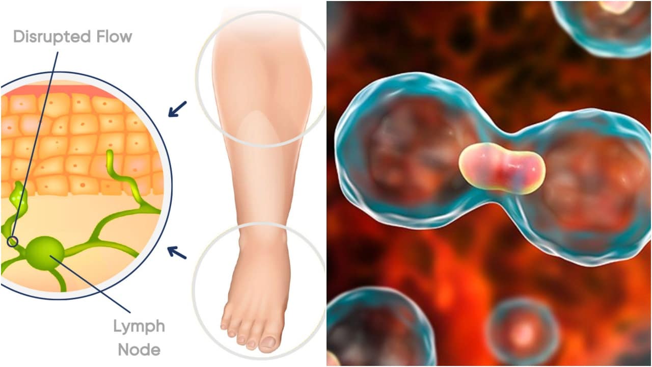 Lymphoedema: The side-effect of cancer nobody talks about - Newsblare
