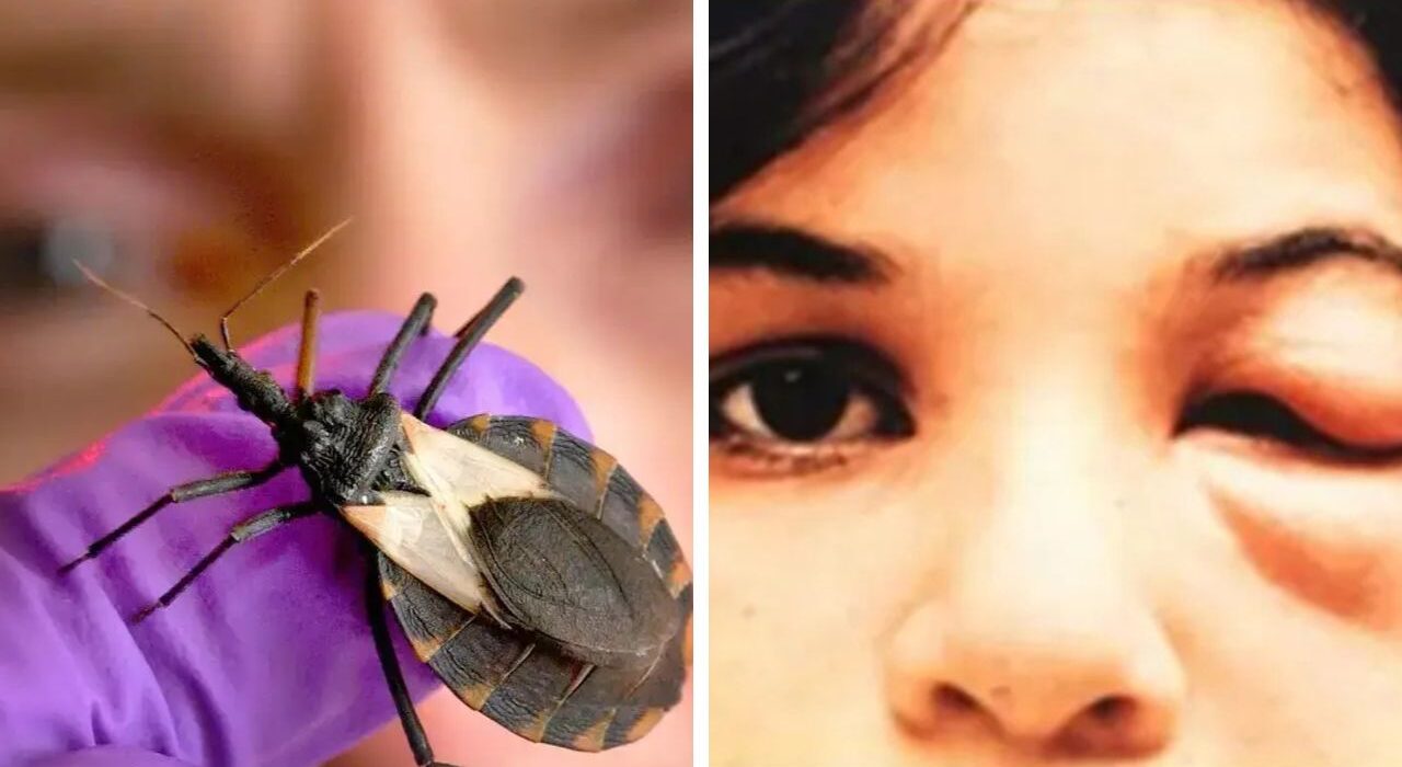 Kissing Bugs Cause Chagas disease, Spread to 32 states in US