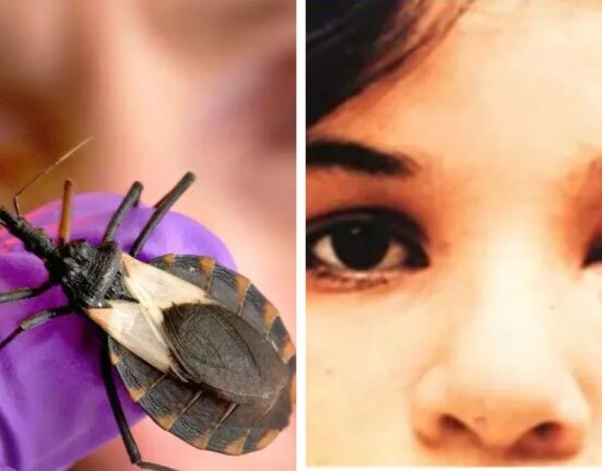 Kissing Bugs Cause Chagas disease, Spread to 32 states in US