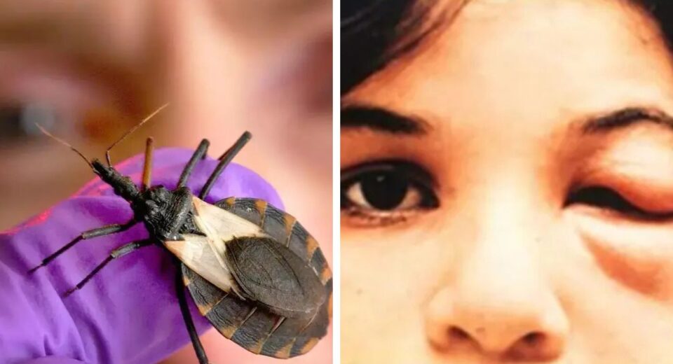 Kissing Bugs Cause Chagas disease, Spread to 32 states in US