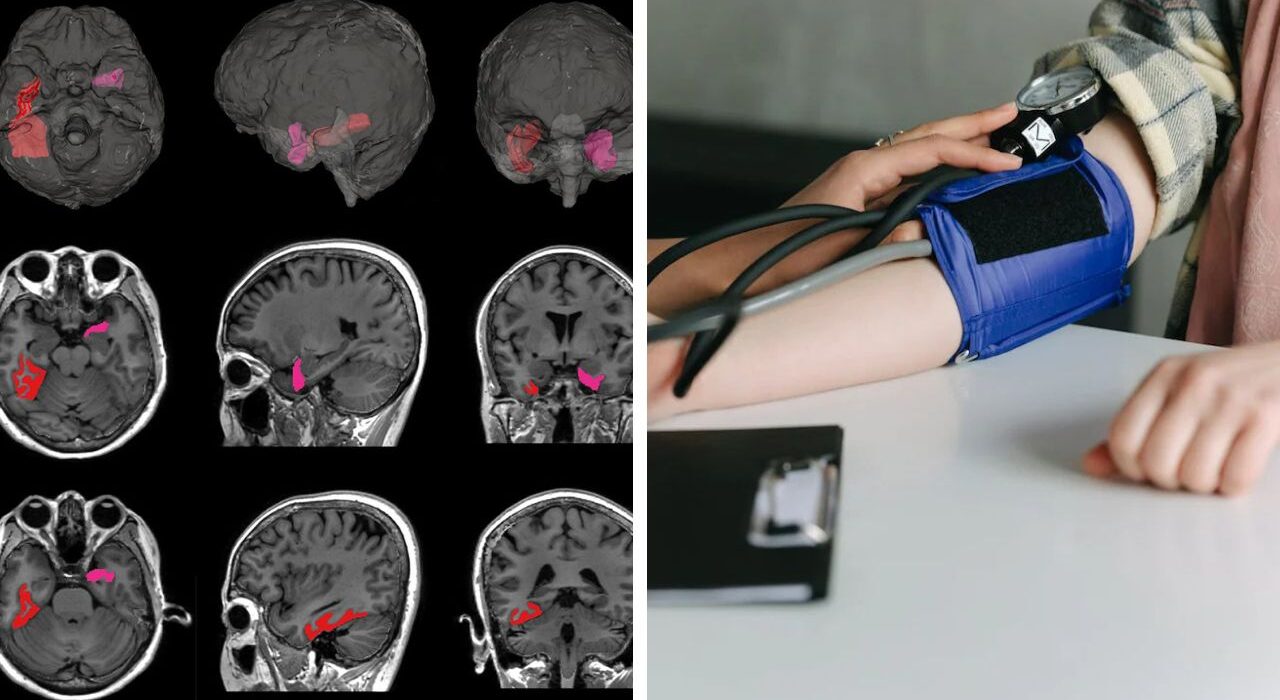 Rapid BP Fluctuations in Elders Signals Risk of Brain Shrinkage