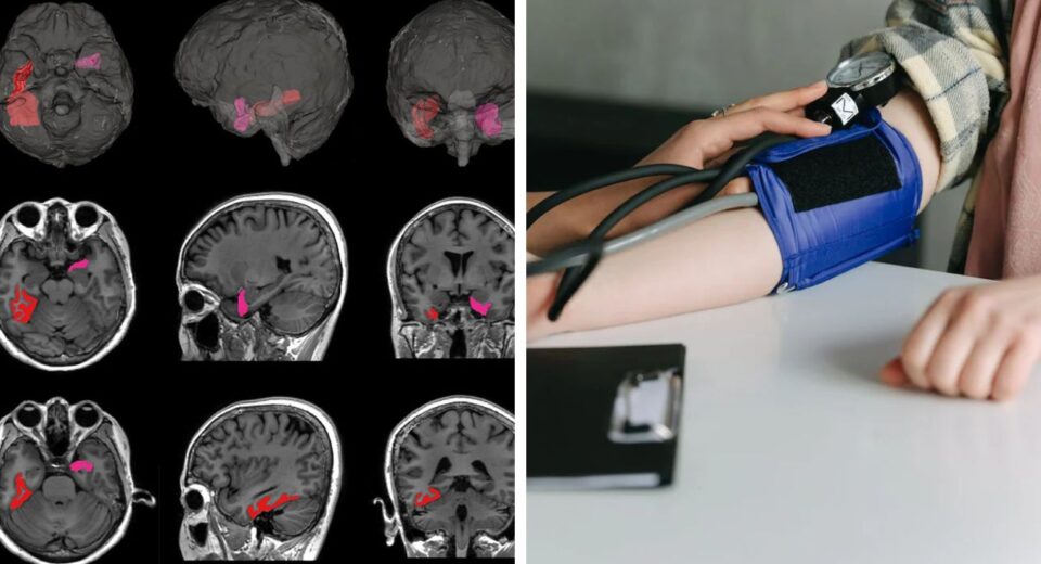 Rapid BP Fluctuations in Elders Signals Risk of Brain Shrinkage