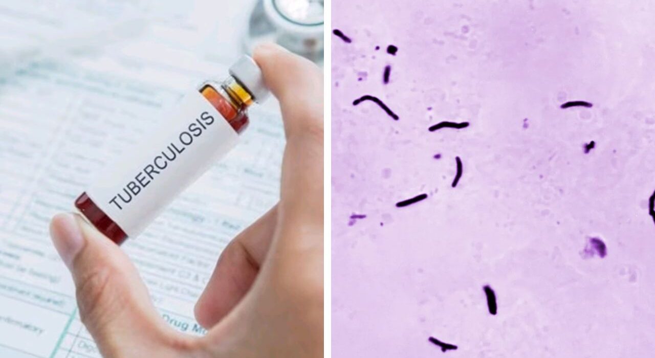 WHO: TB Cases and Deaths Decline in 2024 Amid Funding Shortfalls