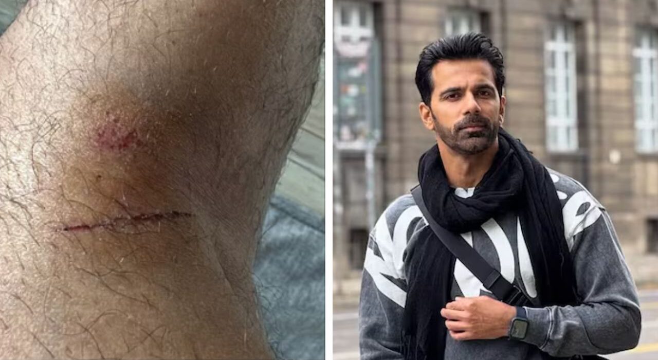 ‘Mental Trauma’: Anuj Sachdeva Speaks After Parking Attack, Reveals Injury Marks