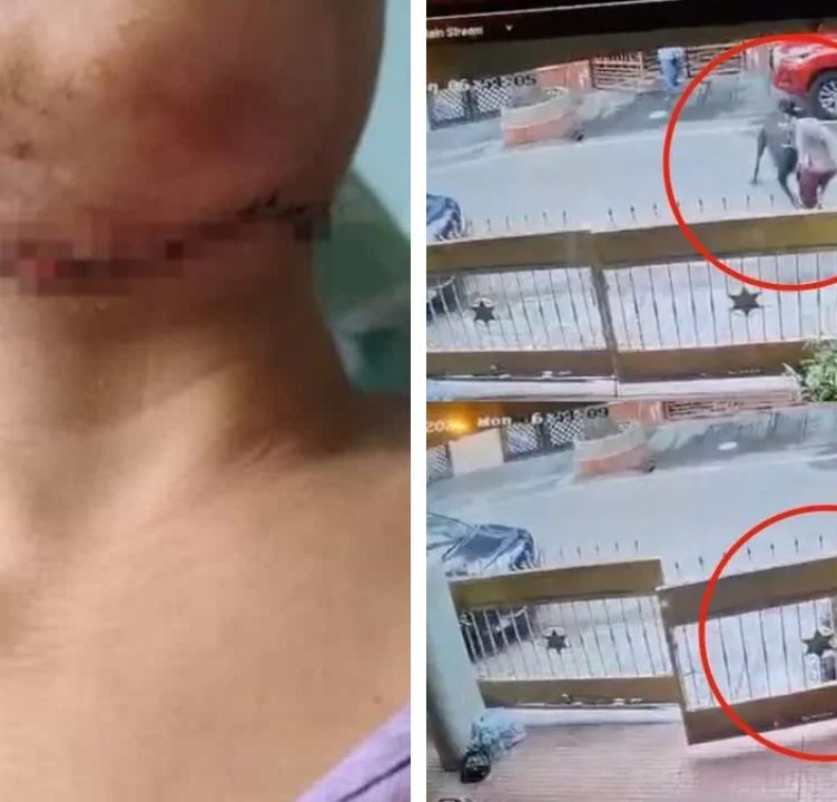 Bengaluru Pet dog attacks on women, Bites face and neck, get 50 Stitches on Body