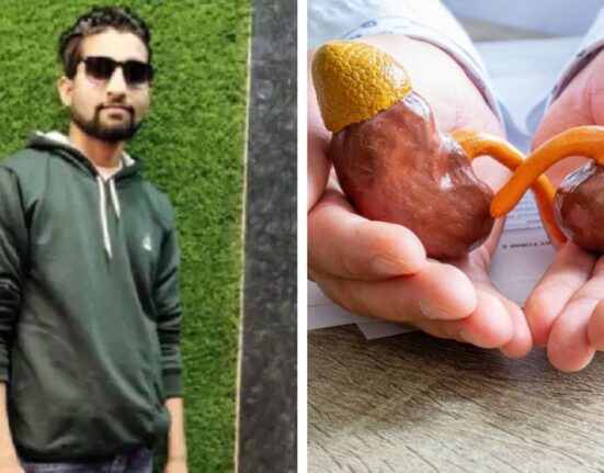 Child admitted for kidney stones in Satna, Madhya Pradesh allegedly loses both kidneys due to doctor's negligence